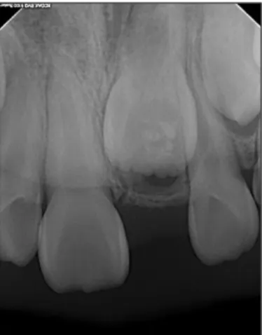 Fig. 8. Button attachment to exposed central incisor. Fig. 9. Panoramic view after orthodontic treatment.