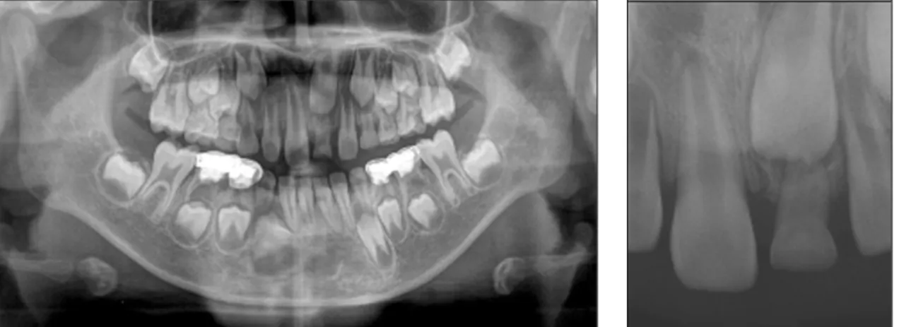 Fig. 11. Initial panoramic and periapical views show an unerupted maxillary left central incisor and retained primary left central incisor.