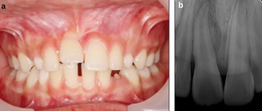 Fig.  2. Almost  closed  root apex  of  upper  right  central incisor.