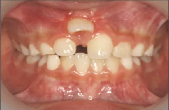 Fig. 7. 1 weeks later after apically repositioned flap. Fig. 8. After 2 months follow up showing spontaneous eruption.