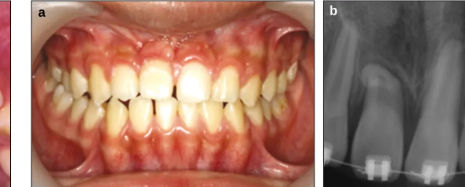 Fig. 13. 2 weeks late after  apically repositioned flap. Fig. 14. After 4 months (a) adequate attached gingiva level, (b) Short root and no marginal bone loss of upper right central incisor.