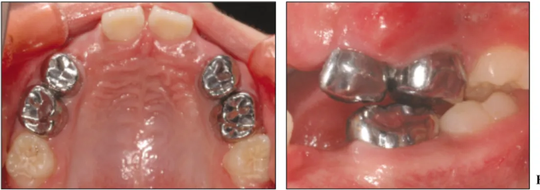 Fig. 3. Periapical radiograph after re-setting of crowns.  
