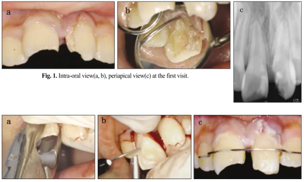 Fig. 1. Intra-oral view(a, b), periapical view(c) at the first visit.