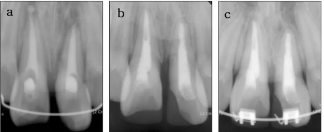 Fig. 3. Radiograph after Intentional replantation. 2 weeks later(a), 7months later(b), 2years later(c).
