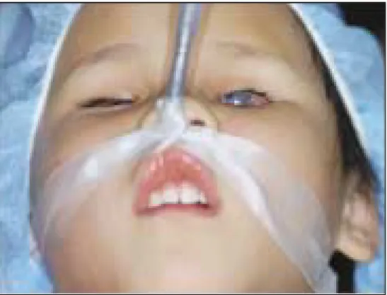 Fig. 2. Characteristic appearance with blindness as the result of protein C deficiency, under general anesthesia.