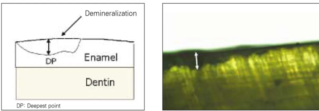 Fig. 4. Measurement of lesion depth in cross-sectioned specimen.