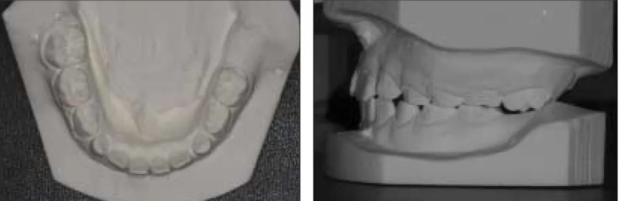 Fig. 2. Panoramic view and occlusal radiograph taken at the first visit. The lower left first permanent molar is deeply impacted (black arrow) with no specific change in size of the dental follicle
