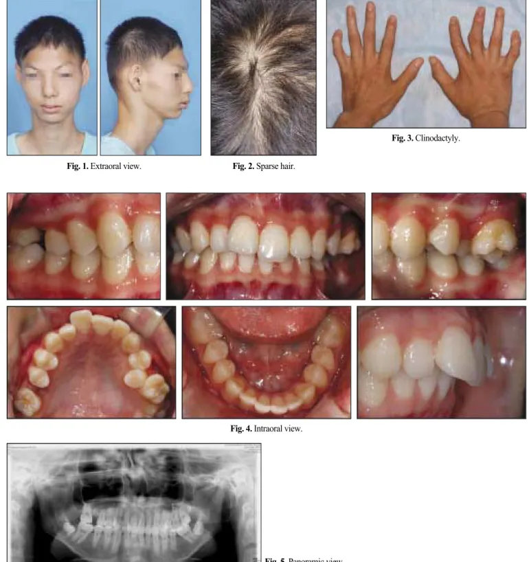 Fig. 3. Clinodactyly.   