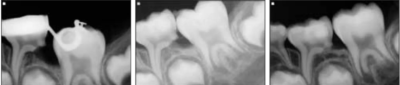 Fig. 4. 9 weeks after appliance delivery. Fig. 5. Insertion of separation elastic. Fig