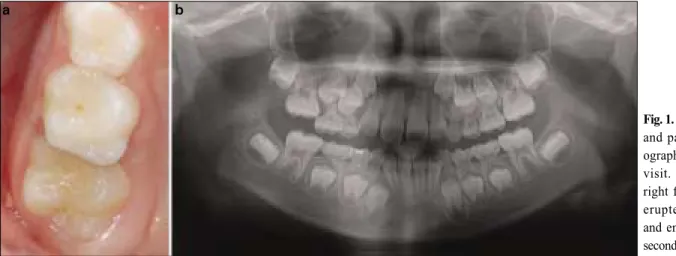 Fig. 2. An elastic separator was inserted between the maxillary right first molar and the second  pri-mary molar.