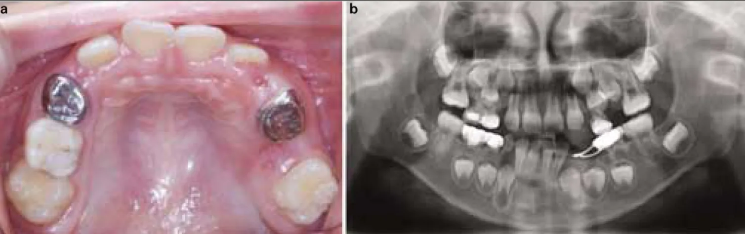 Fig. 6. Intraoral views at 2 months after treatment has been started. The maxillary right first molar was  disim-pacted and erupted normally.
