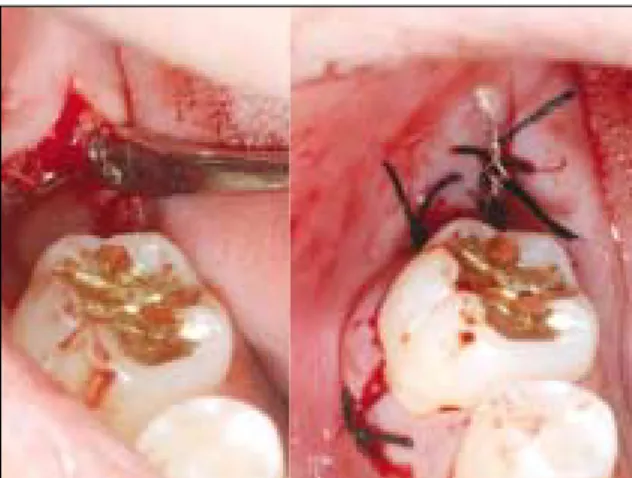 Fig. 11. Modified Halterman appliance was cemented. Fig. 12. Intraoral views(a) and periapical radiographs(b) at 2 months follow up