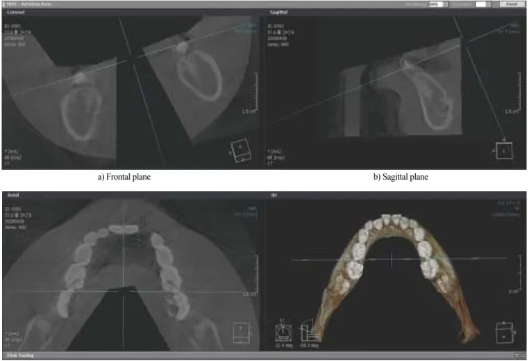 Fig. 1. Example of CT image taking as standard of reference plane.