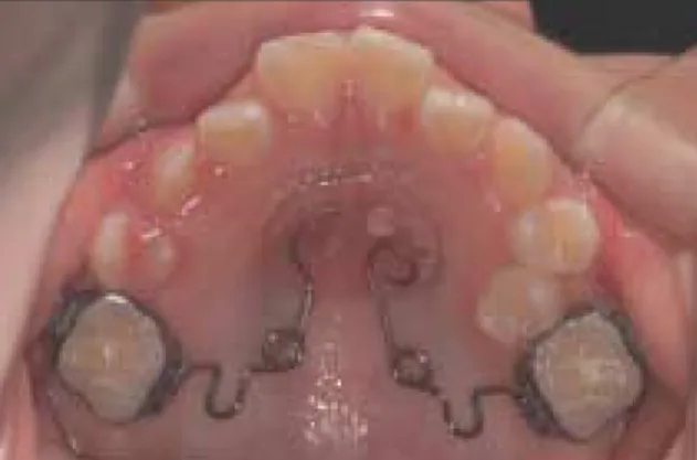 Fig. 3. Occlusal view at 3 weeks after operation. Fig. 4. Delivery of the bone-supported pendulum.