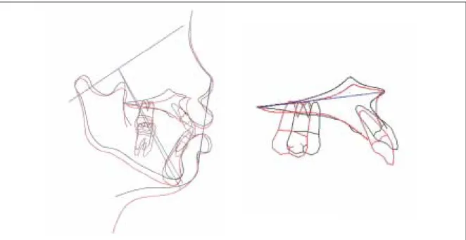 Fig. 12. Occlusal view at 11 months after operation. Space regaining and correction of the anterior labial flaring