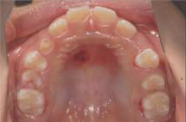 Fig. 18. Occlusal view at 2 weeks after removal. Good healing state. Application of fixed appliance.