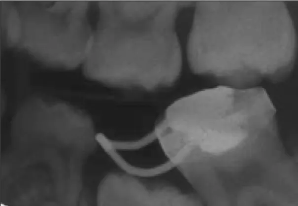 Fig. 3. Panoramic view of 12 months after surgical extraction. Eruption path of mandibular left 2 nd premolar was improved