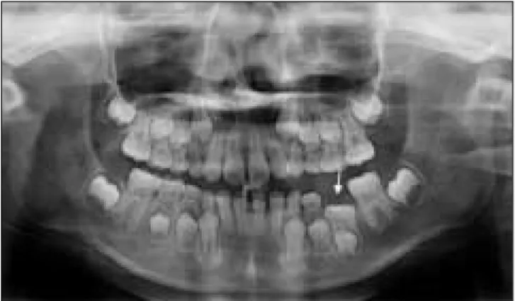 Fig. 6. Intraoral view after extraction of left 2 nd primary molar.