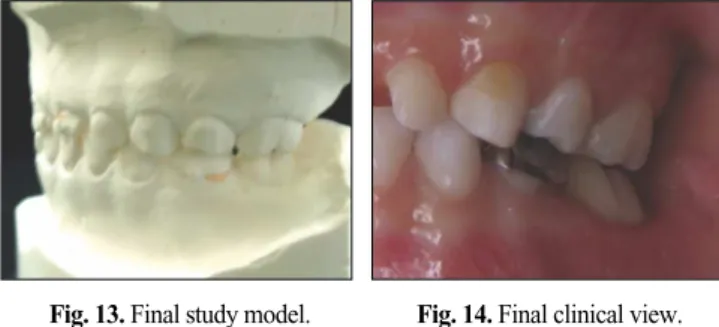 Fig. 13. Final study model. Fig. 14. Final clinical view.