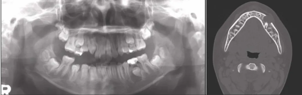 Fig. 2. Panoramic view after the surgery. Fig. 3. Periapical view after the space maintaining.