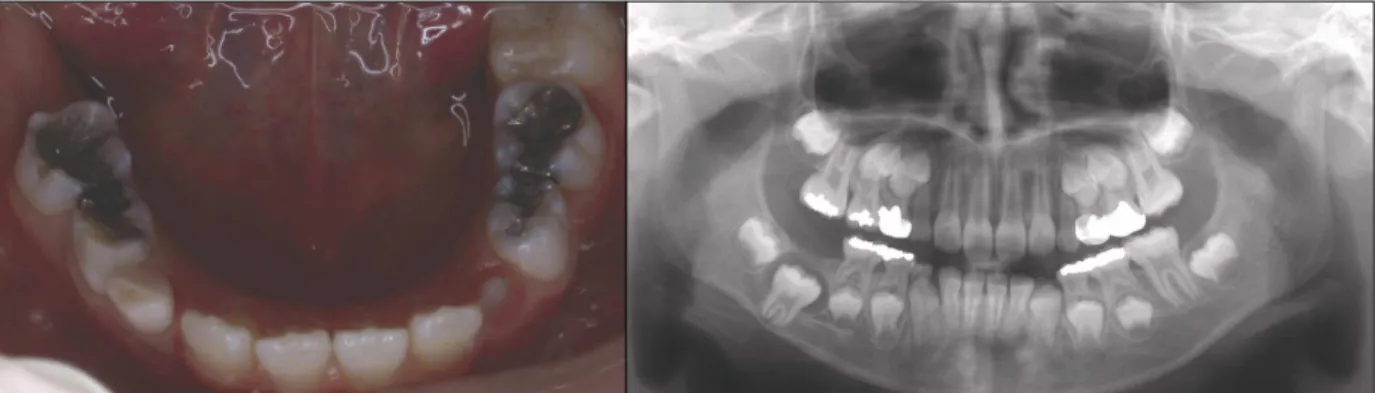Fig. 5. Clinical view and panoramic view at the first examination.