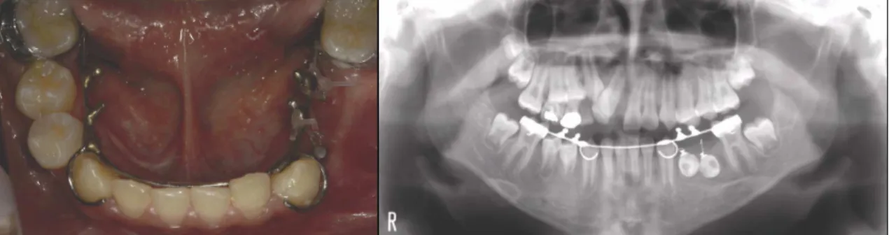 Fig. 11. Clinical view and panoramic view at the orthodontic traction.n