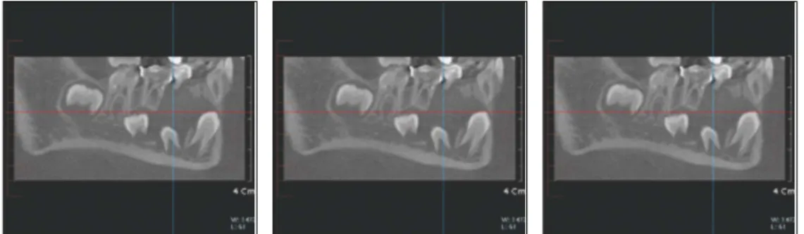 Fig. 2. Initial Cone-Beam Computed Tomography (CBCT), 3D image showing bone loss at the lower right molar area.