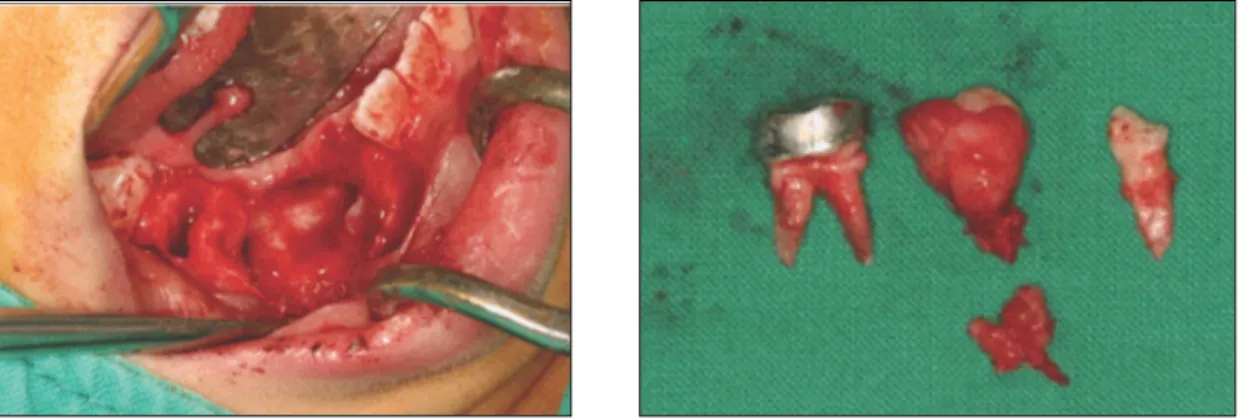 Fig. 8. Retainer for space maintenance.