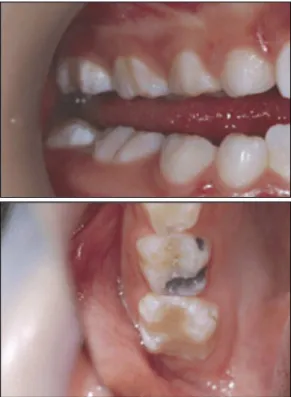 Fig. 5. Moderate fluorosis Fig. 6. Moderate fluorosis.