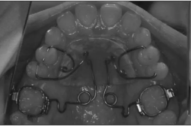 Fig. 3. Occlusal  view  at  3  months  after  pendulum appliance activation. 