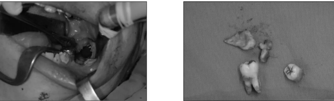 Fig. 6. Surgical removal of mass under general anesthesia.