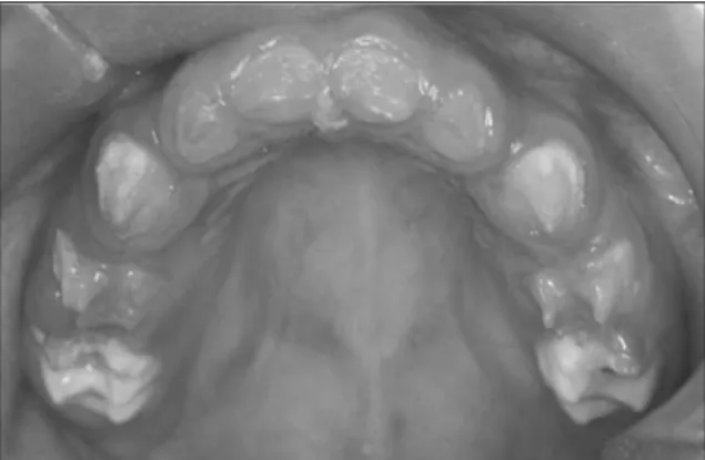 Fig. 1-b. Composite  resin  restoration  by  celluloid crown  in  ant.  teeth  &amp;  stainless  steel  crown restoration in post