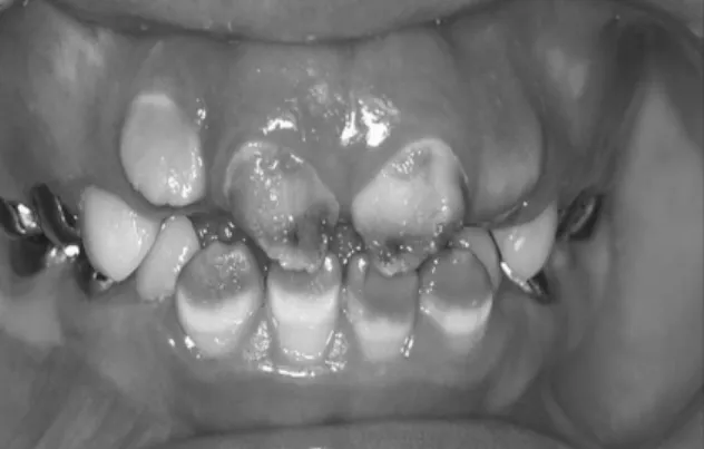 Fig. 3-c. Preparation on Mx. central incisor.