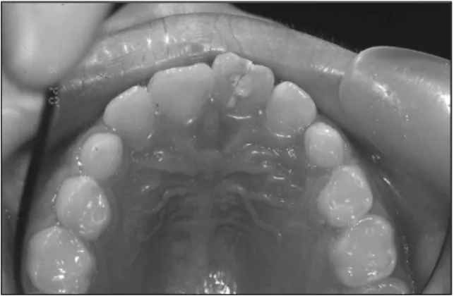 Fig. 3. Resin-wire splinting after surgical extrusion. Fig. 4. Pulp extirpation and ZOE filling