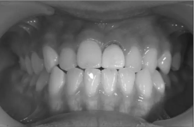 Fig. 16. After 15 months: gutta-percha filling.