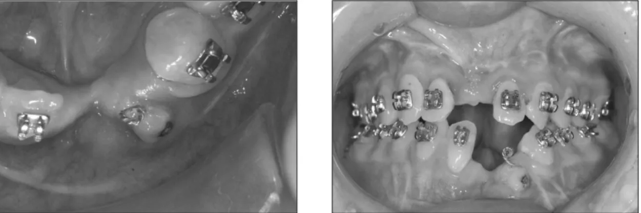 Fig. 7. Intraoral photograph at 6 months after operation.