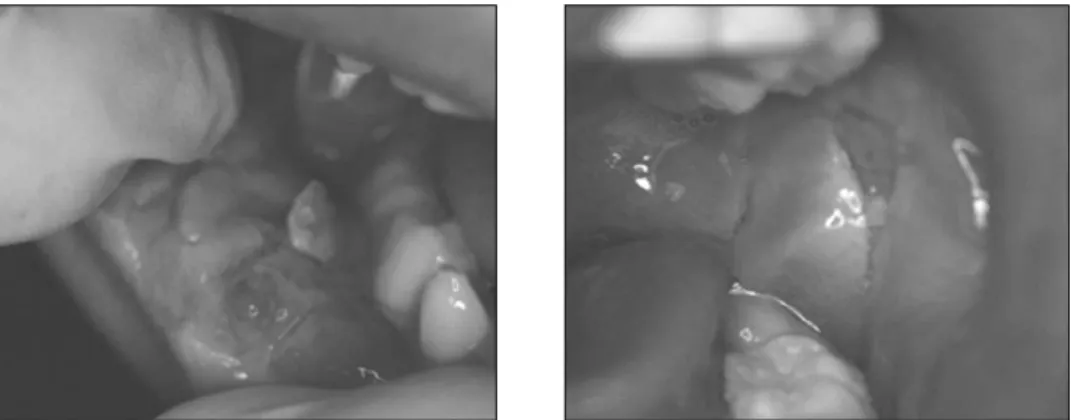 Fig. 1. Intraoral photograph at first visit.