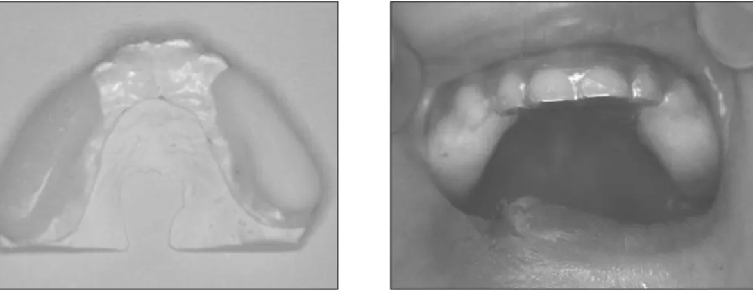 Fig. 3. Clear plate type mouth guard.