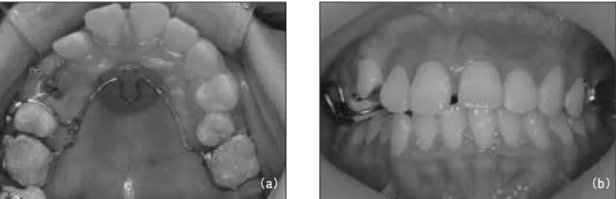 Fig. 2. (a)  At  first,  orthodontic  traction  of  #13  was  done  distally  for  up-righting  (distal  arrow)