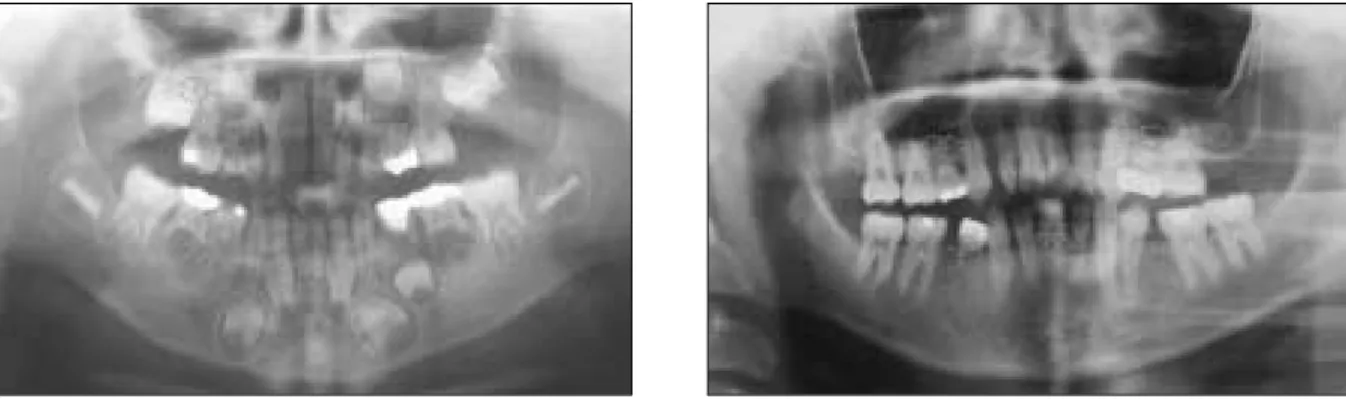 Fig. 8. Radiographs of pretreatment and 10 years later.