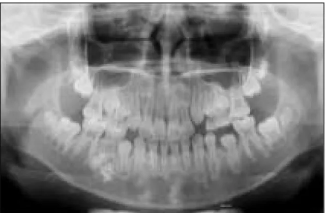 Fig. 3. Compound odontoma. Fig. 4. Panoramic  view  3  months  after  the  surgical enucleation.