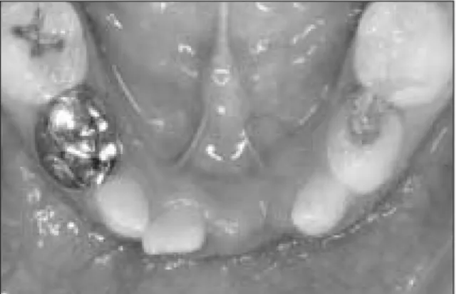 Fig. 7. Compound odontoma. Fig. 8. Panoramic  view  1  month  after  the  surgical enucleation.