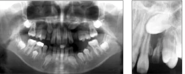 Fig. 1. Initial panoramic and periapical radiographs(case 1).