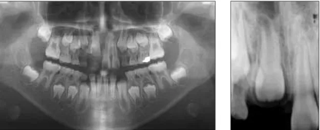 Fig. 5. Initial panoramic and periapical radiographs(case  2).