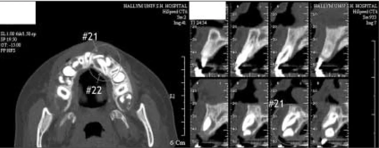 Fig. 2. CT - Axial and sagittal view: First visit.