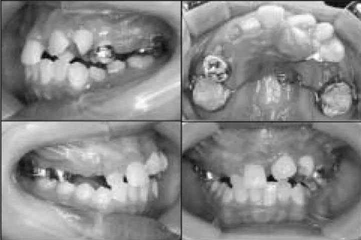 Fig. 3. Orthodontic traction : Modified TPA with loop. Fig. 4. Space reganing : Pendulum appliance.
