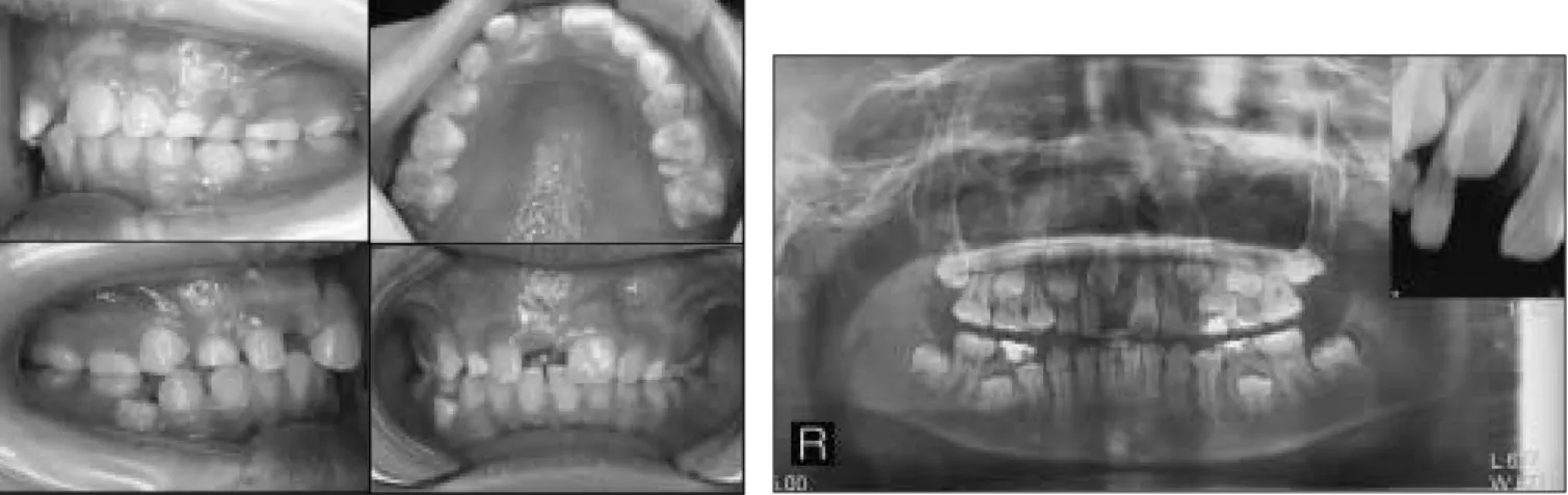 Fig. 8. Intraoral view : First visit Fig. 9. Panoramic and periapical view : First visit.