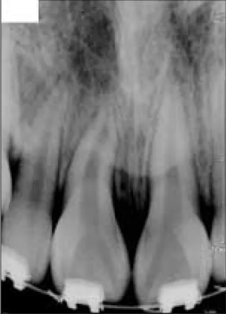 Fig. 12. Periapical view : 2 months after orthodontic traction.