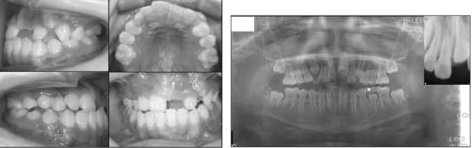 Fig. 17. Intraoral view : First visit. Fig. 18. Panoramic and periapical view : First visit.