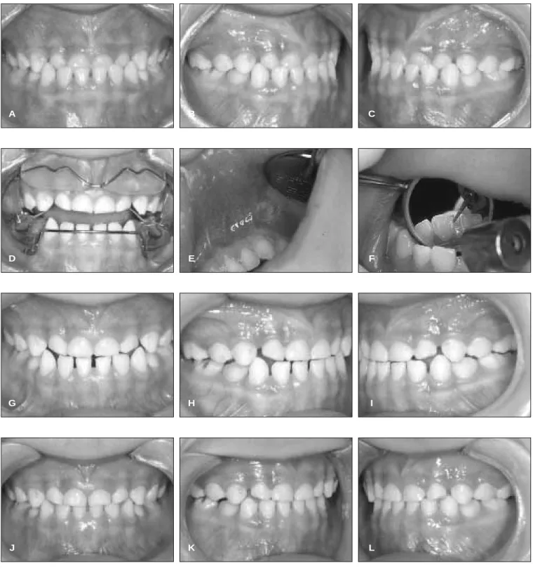 Fig. 10. A, B, C : 치료전 구강소견